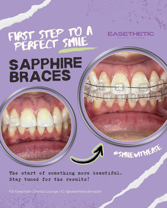 Sapphire Braces