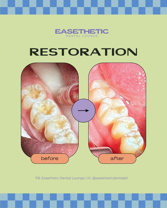 Tooth Restoration (Pasta)