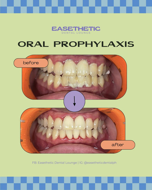 Oral Prophylaxis (Cleaning)