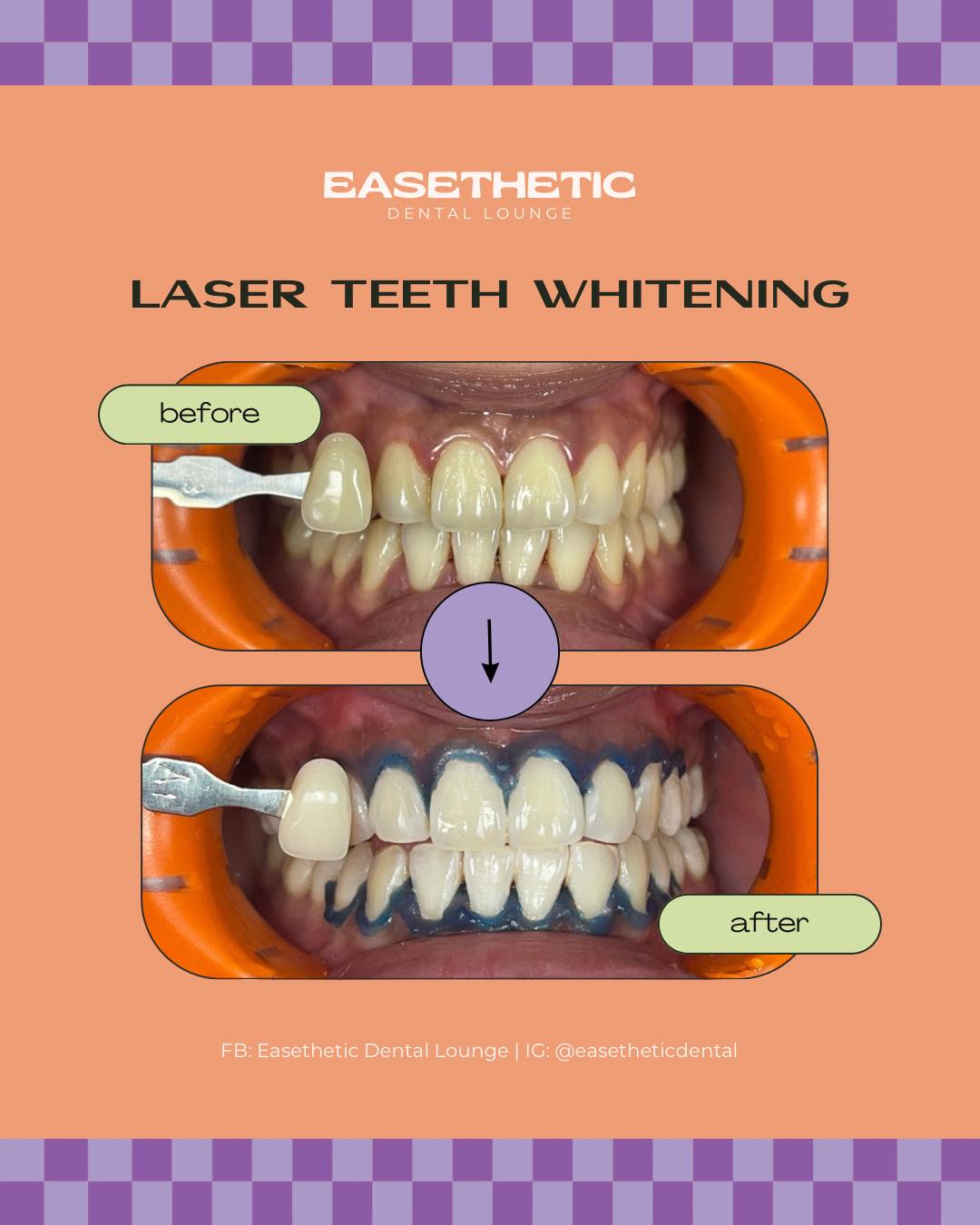 Teeth Whitening