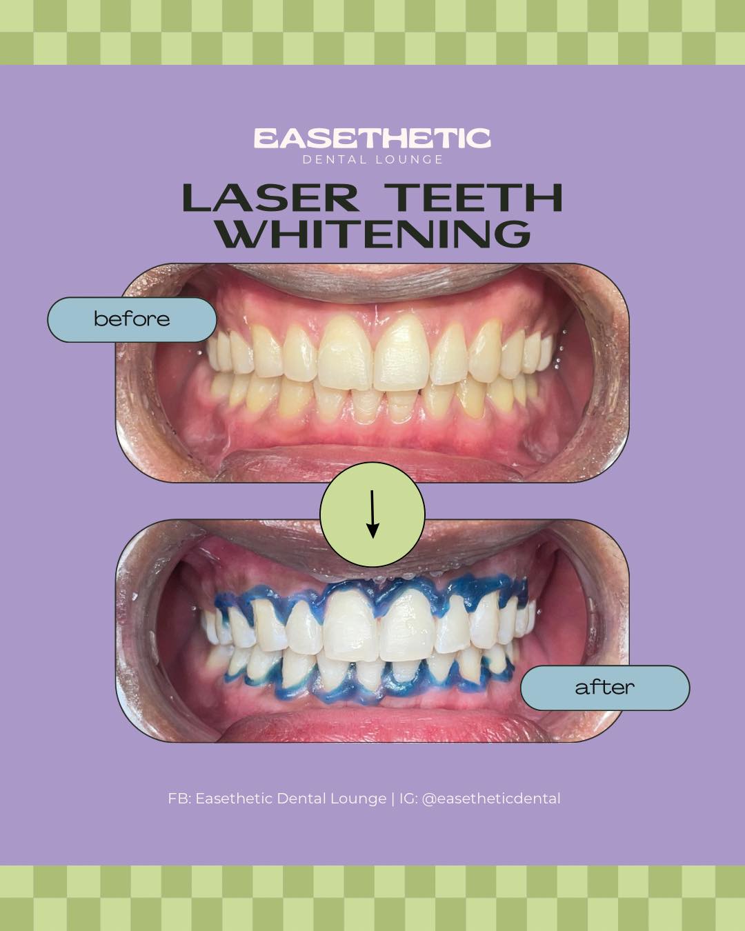 Teeth Whitening