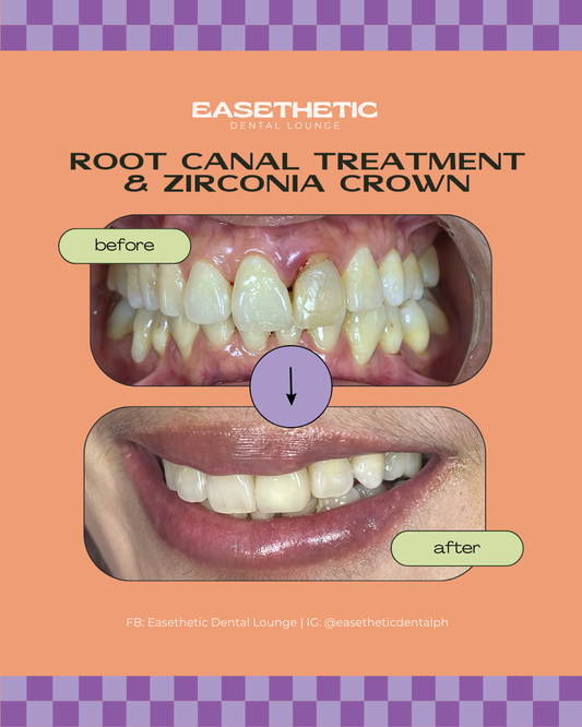 Root Canal Treatment
