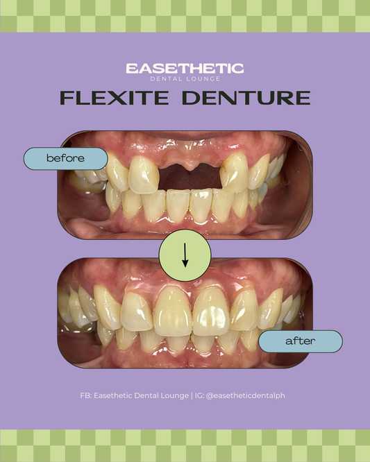 Dentures (Pustiso)