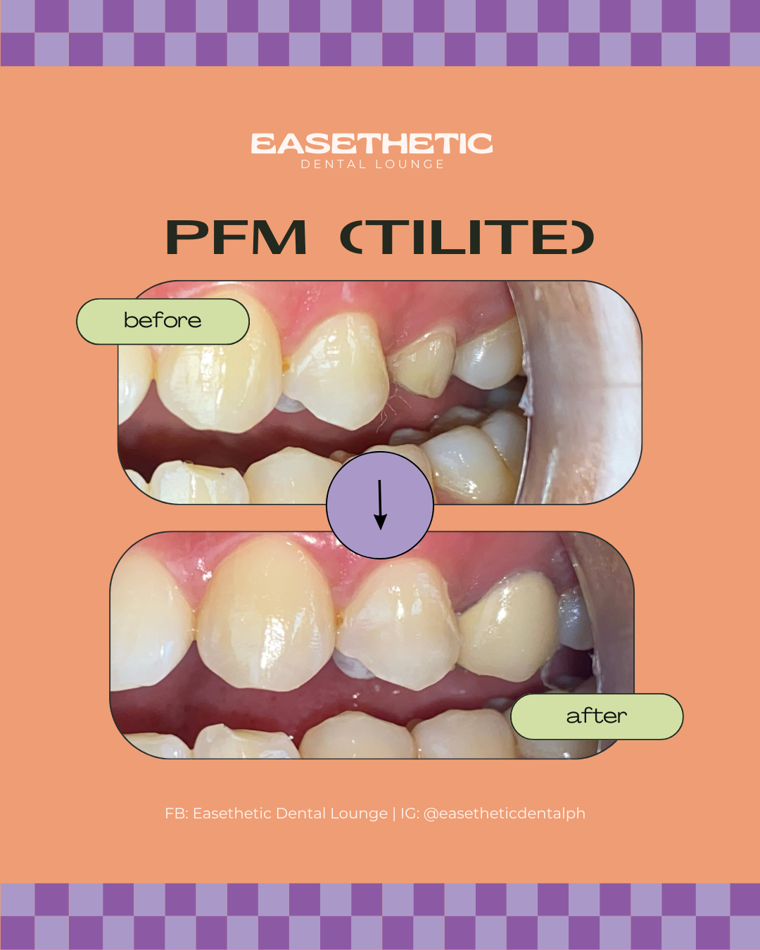 Porcelain Fused to Metal (Tilite)