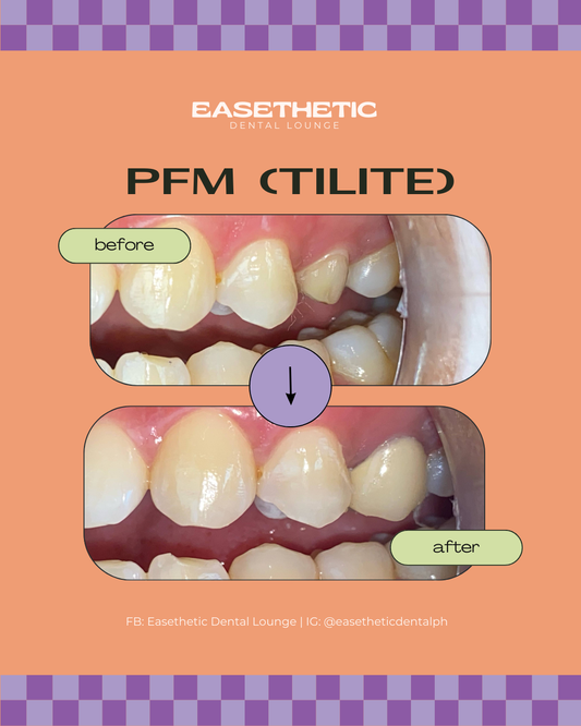 Porcelain Fused to Metal (Tilite)