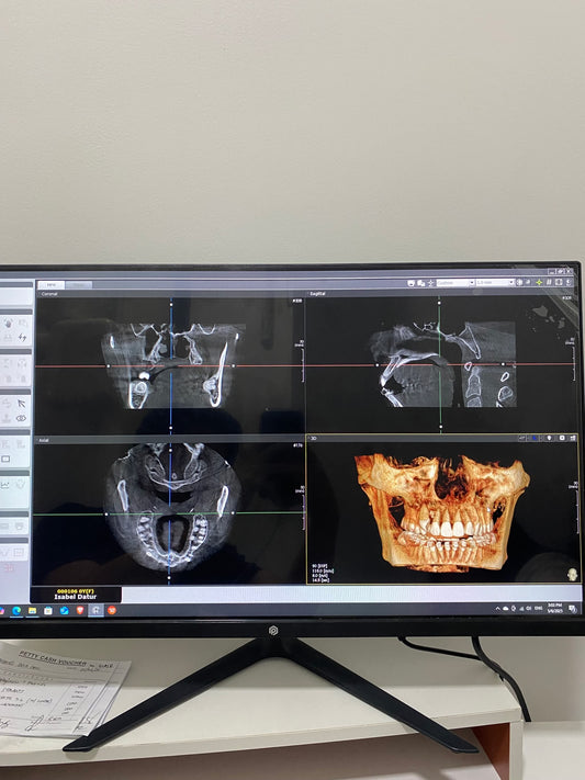 CBCT Scan (Cone Beam Computed Tomography)