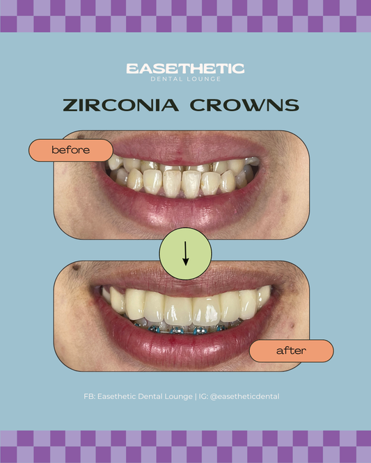 Durable Zirconia Crowns in Quezon City - Aesthetic Dentistry