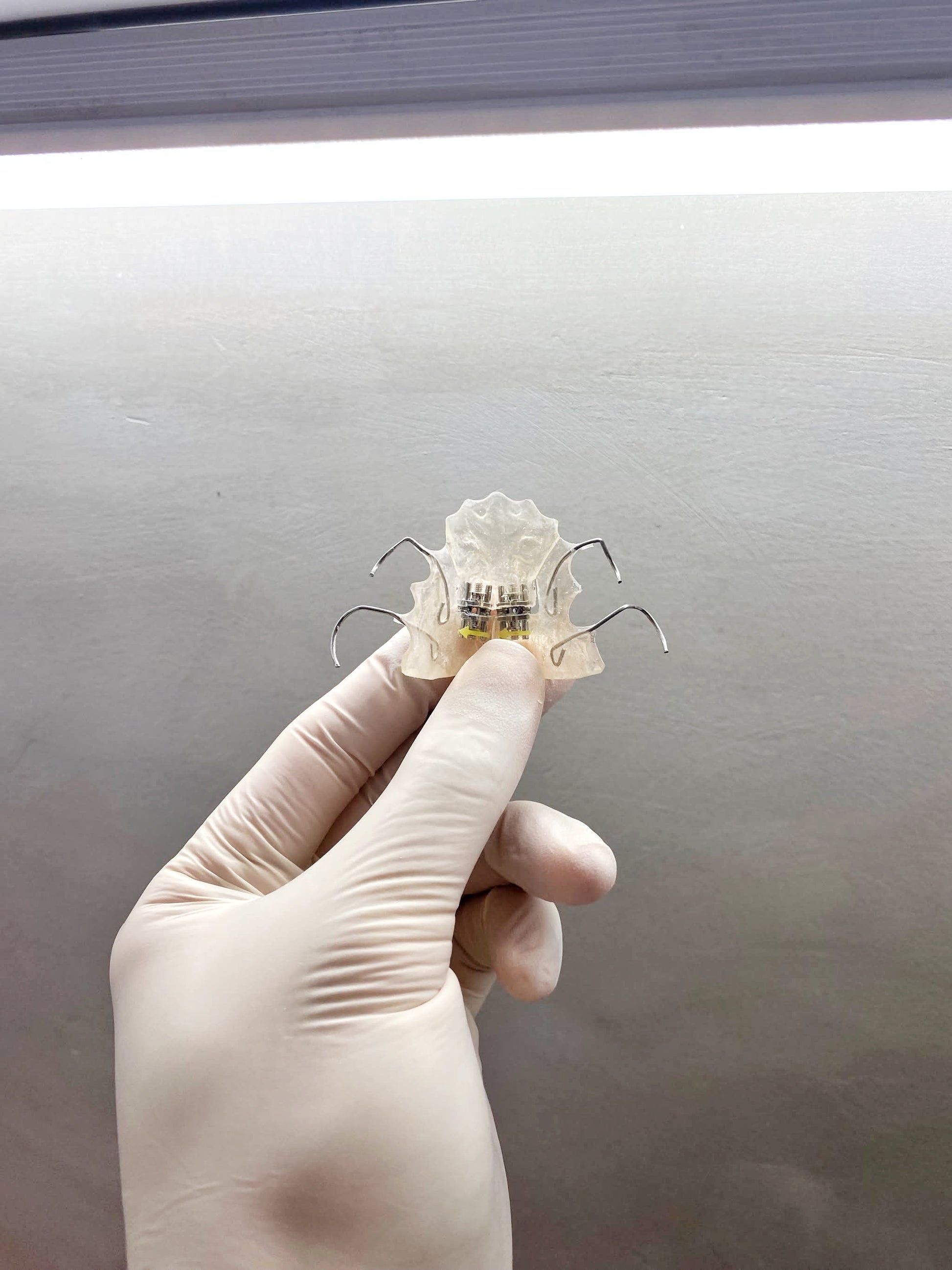 Orthodontic appliances for teeth alignment at Easethetic Dental Lounge in Quezon City