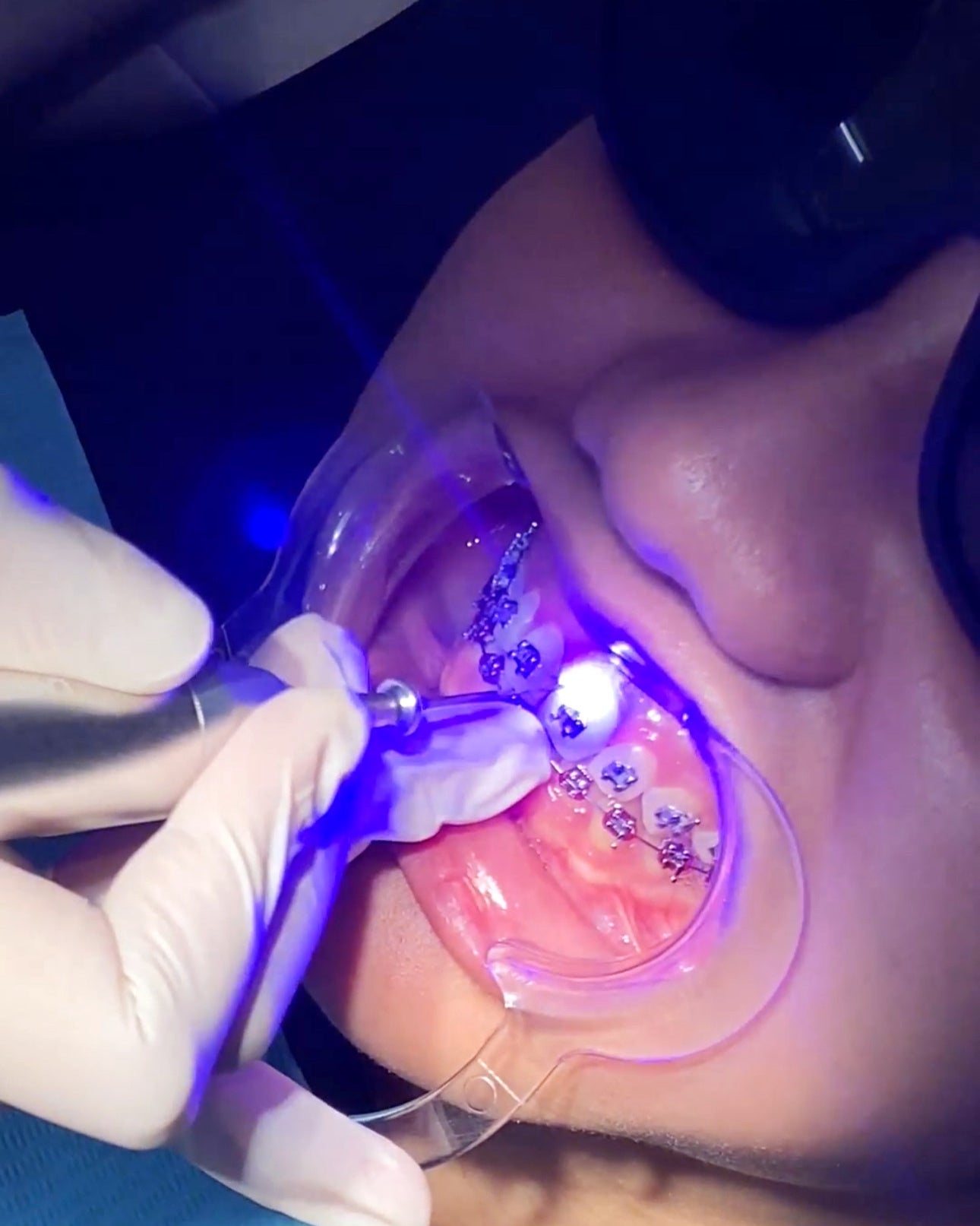 Gum reshaping surgery (gingivectomy) at Easethetic Dental Lounge, trusted dental clinic in QC