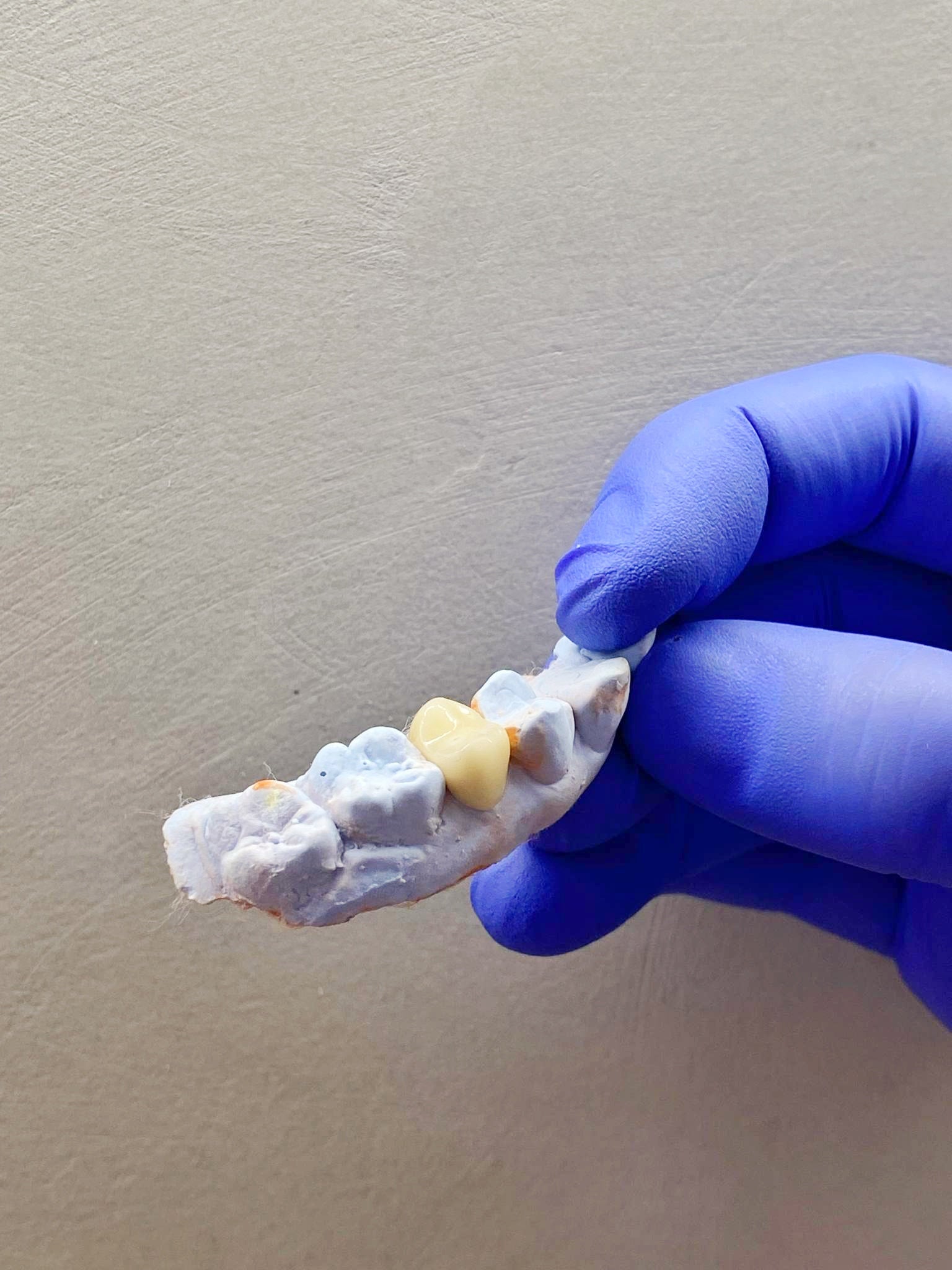 Porcelain fused to metal (PFM) Tilite crowns at Easethetic Dental Lounge in Quezon City for durable and aesthetic dental restorations