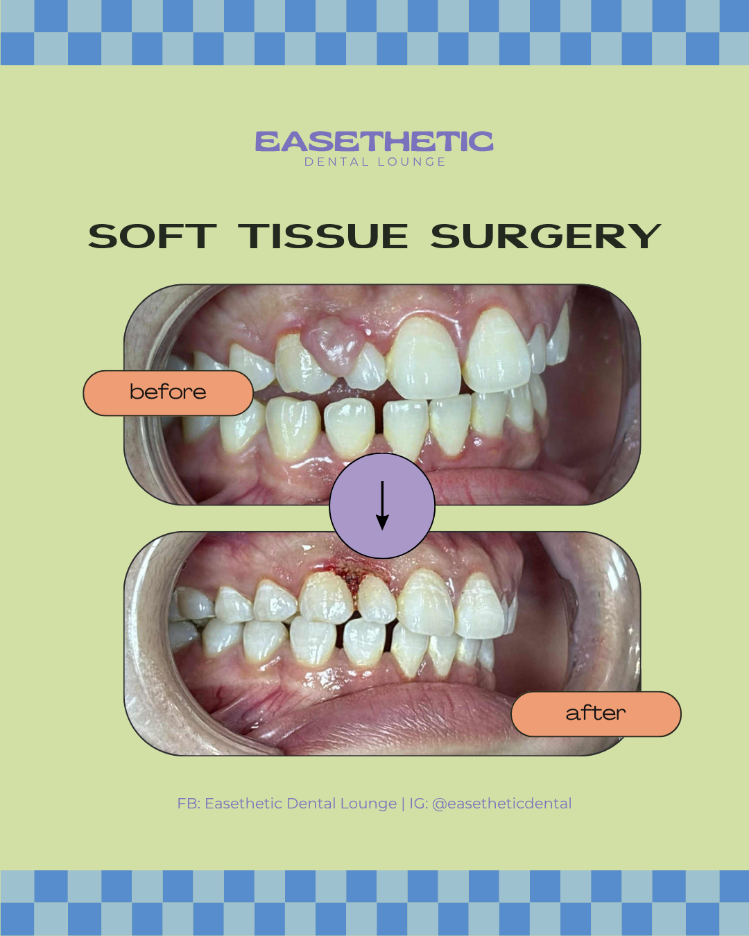 Successful periodontal soft-tissue surgery result, showing healthy and naturally aesthetic gums in a Quezon City patient.