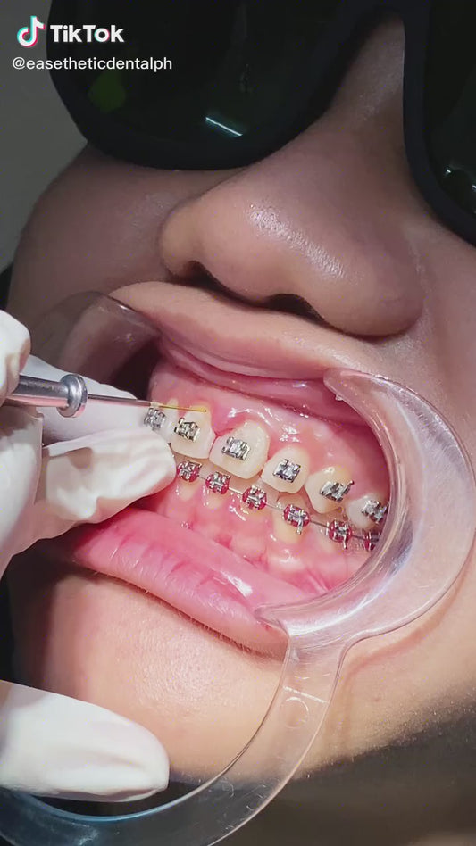 Gingivectomy/Crown Lengthening