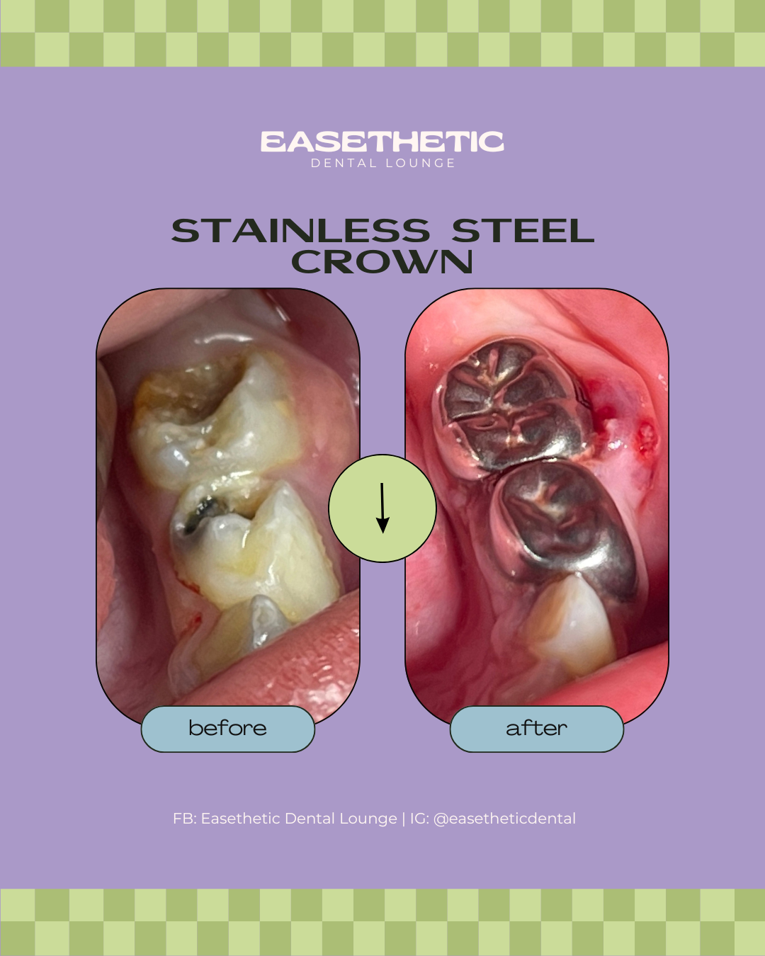 Pediatric Stainless Steel Crown fitted securely on a child's molar teeth in our professional Quezon City dental clinic