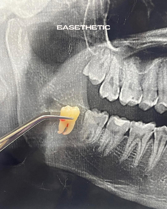 Odontectomy (Wisdom Tooth Removal)