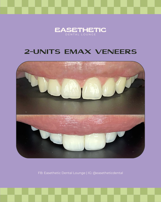 Veneers