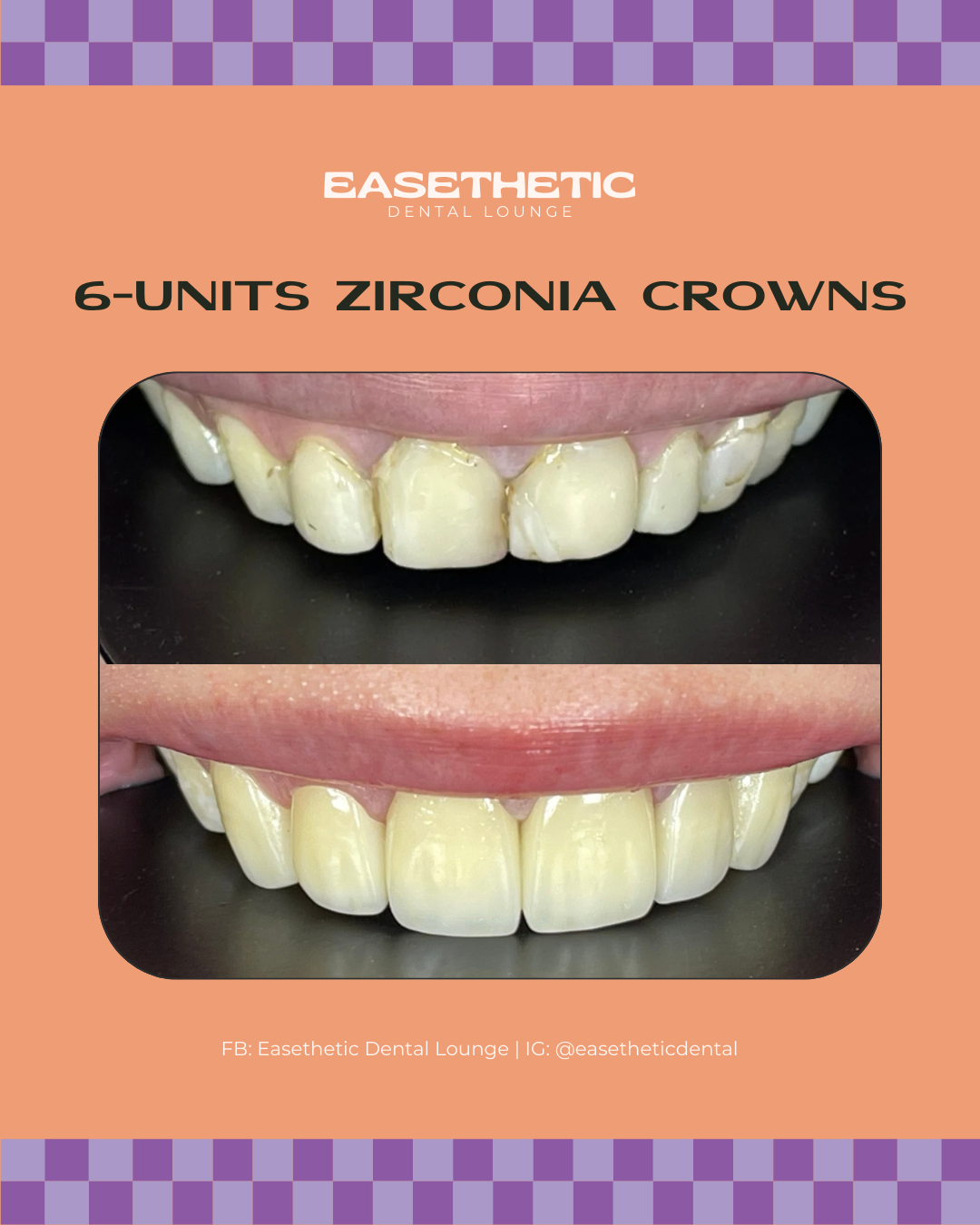 Zirconia Crowns