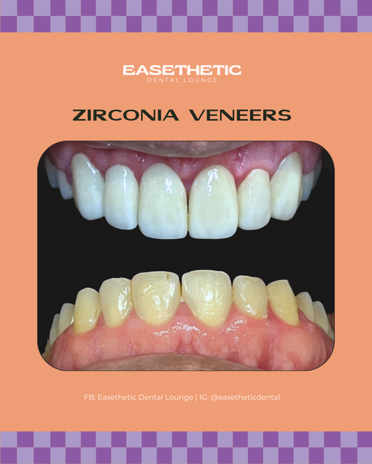 Veneers