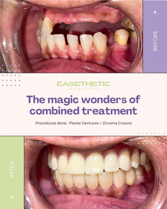 Dentures (Pustiso)