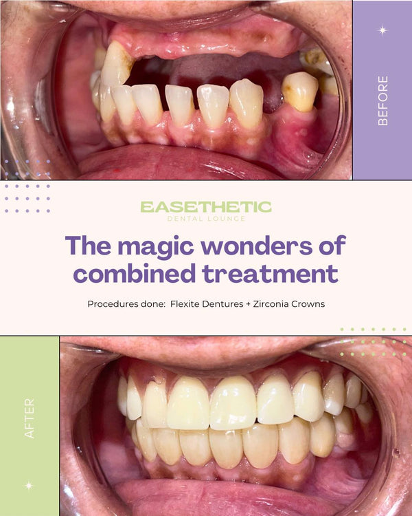 Dentures (Pustiso) | Replace Missing Teeth | QC Dental – Easethetic ...