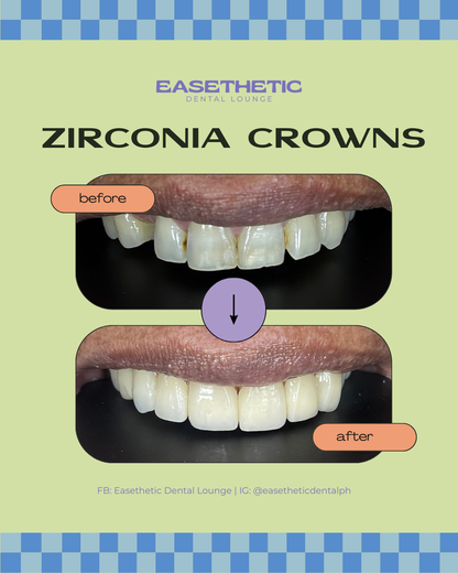 Zirconia Crowns