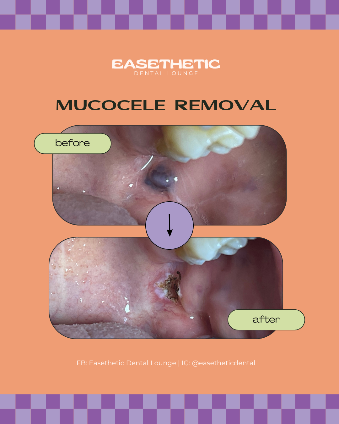 Ranula (mucocele) excision procedure from the floor of the mouth