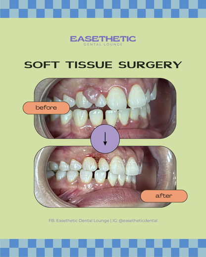 Successful periodontal soft-tissue surgery result, showing healthy and naturally aesthetic gums in a Quezon City patient.