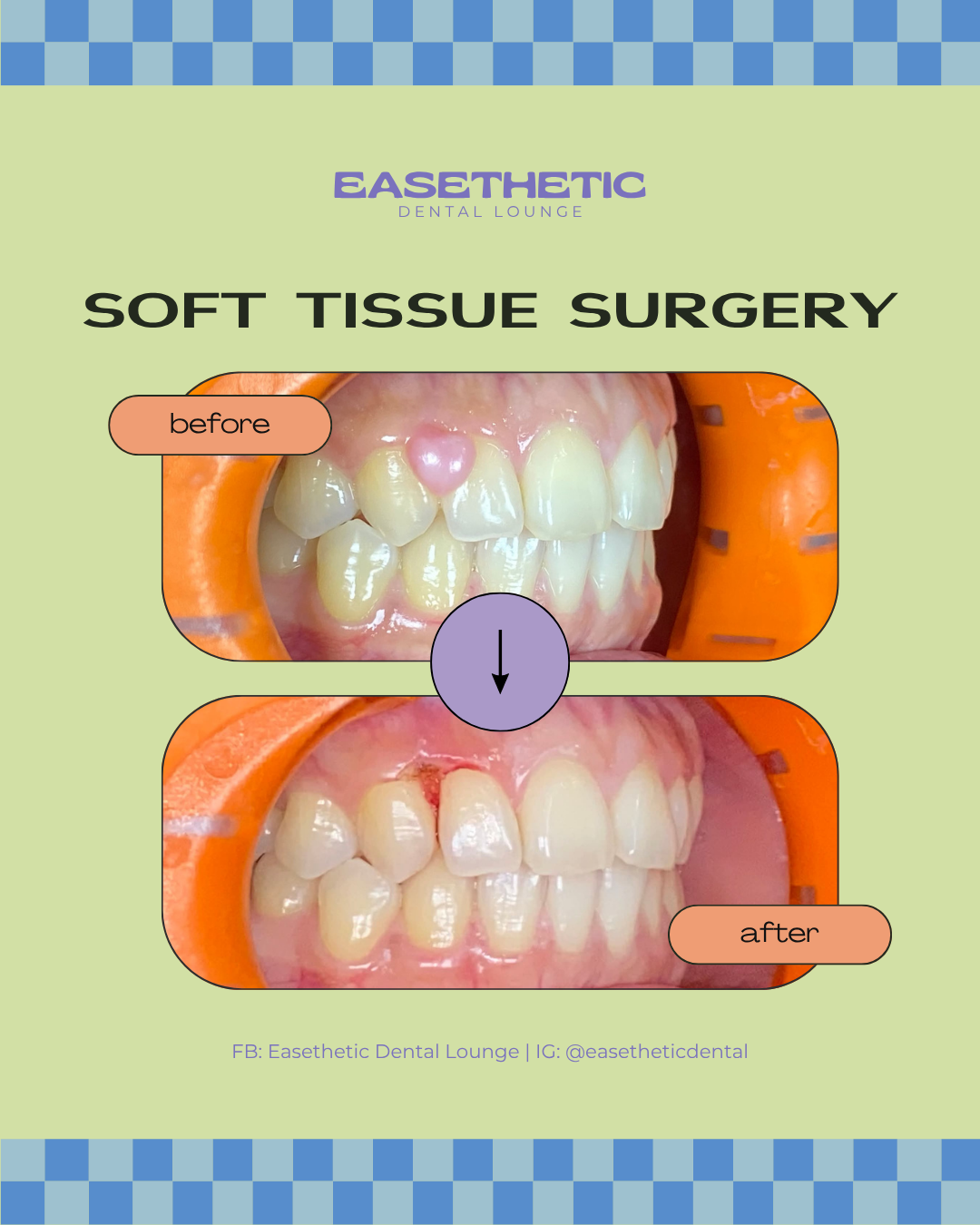 Aesthetic soft-tissue surgery (gingivectomy/gum contouring) to correct a gummy smile in Quezon City dental clinic.